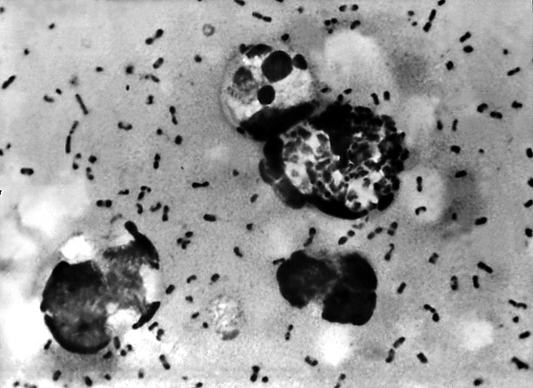 A bubonic plague smear